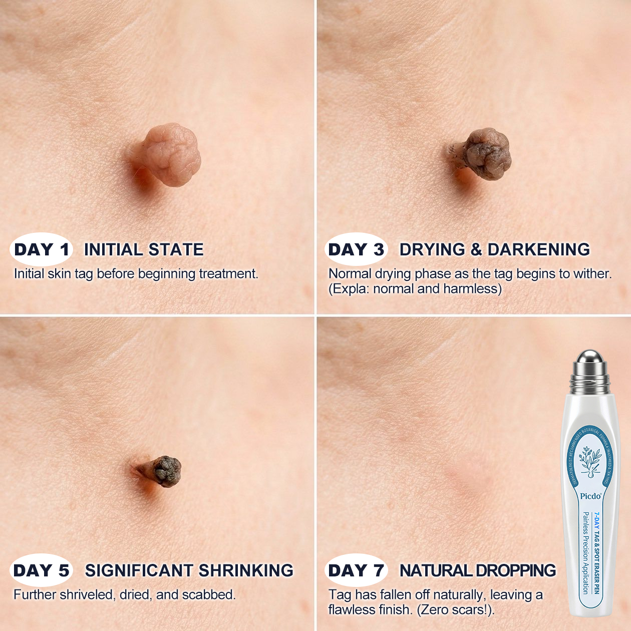 🪐𝐏i𝐜𝐝o® 7-𝐷𝑎𝑦 𝗧𝐚𝐠 & 𝗦𝗽𝐨𝐭 𝐄𝐫𝒂𝒔𝒆𝒓(Zero Pain, Zero 𝐒𝐜𝐚𝒓𝒔 Rollerball)💪