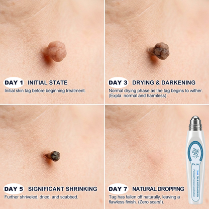 🪐𝐏i𝐜𝐝o® 7-𝐷𝑎𝑦 𝗧𝐚𝐠 & 𝗦𝗽𝐨𝐭 𝐄𝐫𝒂𝒔𝒆𝒓(Zero Pain, Zero 𝐒𝐜𝐚𝒓𝒔 Rollerball)💪
